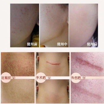 南陽優(yōu)瑪疤痕修復(fù)中心VIP管