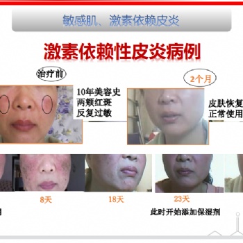 得了激素臉怎么辦:正確對待戒斷反應，廣州怡嘉生物科技